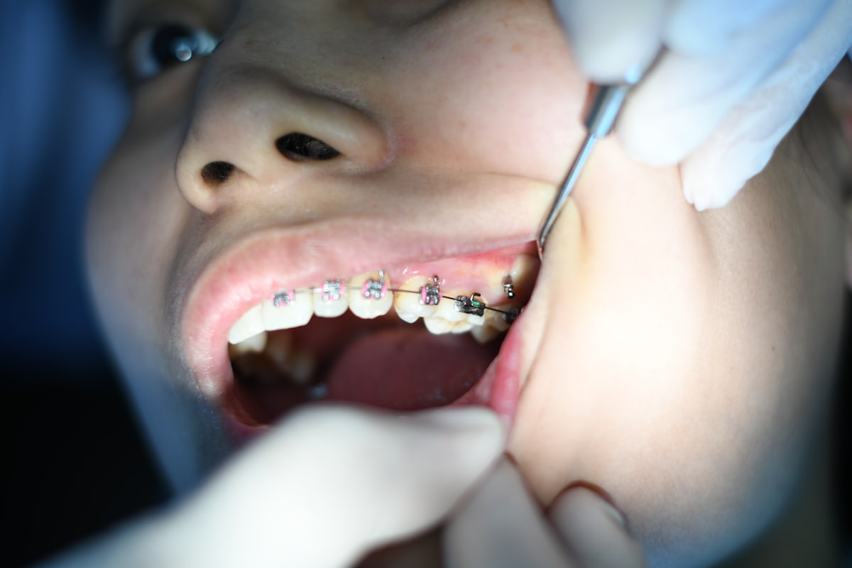 Close-up de sorriso com aparelho ortodôntico fixo